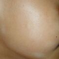 misuse_antifungal020805.jpg