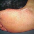 misuse_antifungal2000-262.jpg