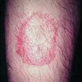 misuse_antifungal2000-39.jpg
