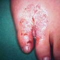 misuse_antifungal9-1071.jpg
