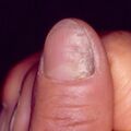 misuse_antifungal9-338.jpg