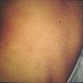 misuse_antifungal9-444.jpg