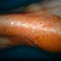 misuse_antifungal9-639.jpg