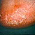 misuse_antifungal9-823.jpg