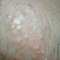 misuse_bactroban010611.jpg