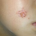 misuse_bactroban020614.jpg