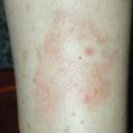 misuse_bactroban020819.jpg