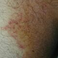 misuse_broderm020813.jpg
