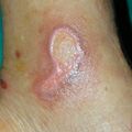 misuse_burn010410.jpg