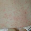 misuse_caladramine020829-2.jpg