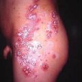 misuse_caladramine2000-320.jpg