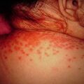 misuse_candidiasis2000-263.jpg