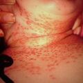 misuse_candidiasis2000-264.jpg