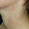 misuse_canesten020806-2.jpg