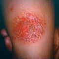misuse_canesten9-30.jpg