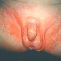 misuse_canesten9-695.jpg