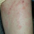 misuse_celestoneg_madecassol020807-1.jpg