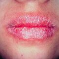 misuse_cheilitis2000-40.jpg