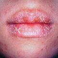 misuse_chelitisexfoliativa_acyclovir2000-55.jpg