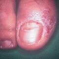 misuse_clotrimazole2000-203.jpg