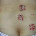 misuse_cupping010424.jpg