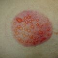 misuse_cupping010726.jpg