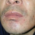 misuse_dermasone020420.jpg