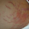 misuse_dermasone020807-2.jpg