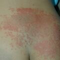 misuse_dermatop020717.jpg