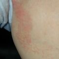 misuse_dermatop020806.jpg
