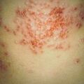 misuse_dermatop2000-270.jpg