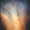 misuse_dermatop2000-410.jpg
