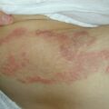 misuse_dermovate010728.jpg