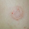 misuse_dermovate020406-1.jpg