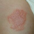 misuse_dermovate020406-2.jpg