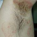 misuse_dermovate020506.jpg