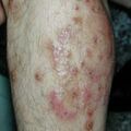 misuse_dermovate020702.jpg