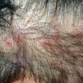 misuse_dermovate020902.jpg