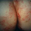 misuse_dermovate9-349.jpg