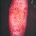 misuse_dermovate9-851.jpg