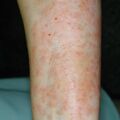 misuse_dermovate_naricort020816-1.jpg