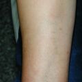 misuse_dermovate_naricort020918-1.jpg