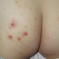 misuse_dethasone020823.jpg