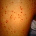 misuse_econapen_acne9-303.jpg