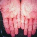 misuse_erythemamultiforme2000-177.jpg