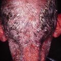 misuse_exfoliativedermatitis2000-326.jpg