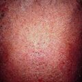 misuse_exfoliativedermatitis2000-327.jpg