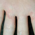 misuse_fluocinolone011008-1.jpg