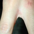 misuse_fluocinolone011008-2.jpg