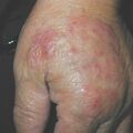 misuse_fucidate010820.jpg